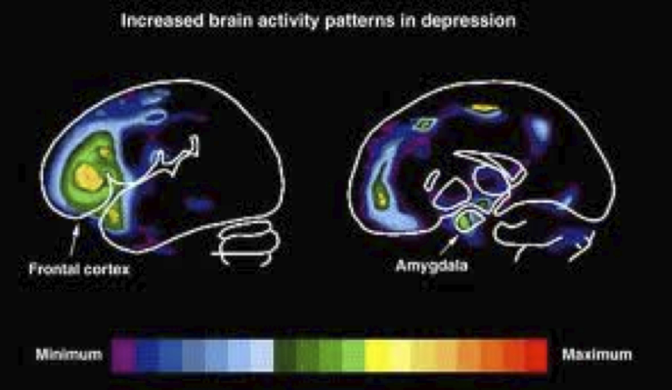 Повышение активности мозга. Активность мозга. Мозг депрессивного больного. Активность мозга при депрессии.